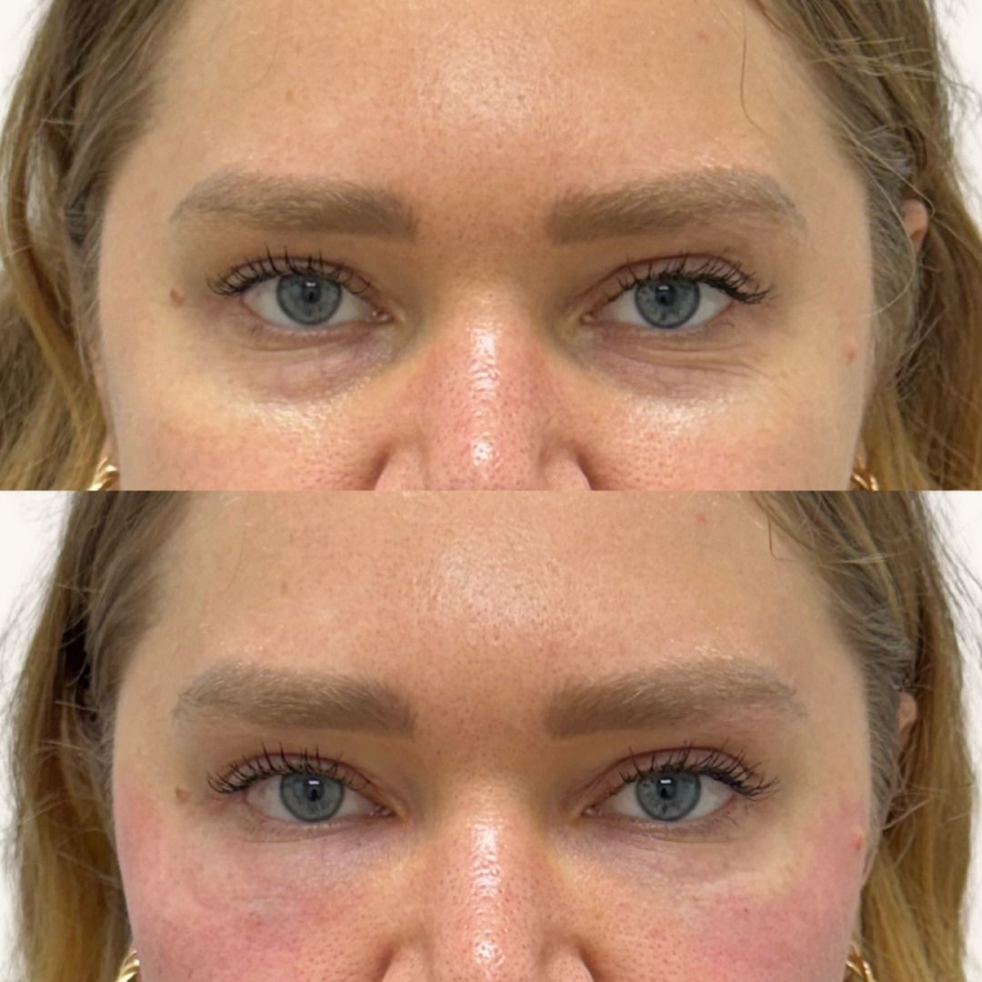 Platelet-Rich Plasma Before & After